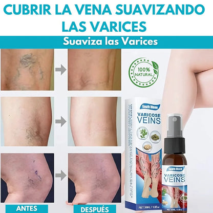 (SUPER 2X1) Spray Anti-Varices 100% Natural